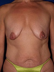 Breast Augmentation With Lift Before & After