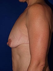 Breast Augmentation With Lift Before & After