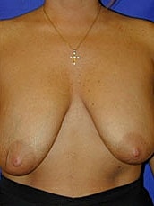 Breast Augmentation With Lift Before & After