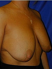 Breast Augmentation With Lift Before & After
