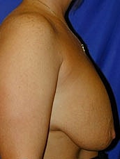 Breast Augmentation With Lift Before & After