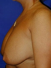 Breast Augmentation With Lift Before & After