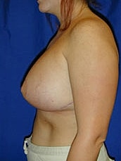 Breast Augmentation With Lift Before & After