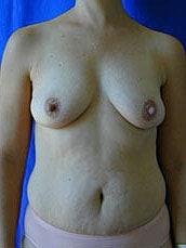 Breast Augmentation With Lift Before & After