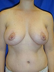Breast Augmentation With Lift Before & After