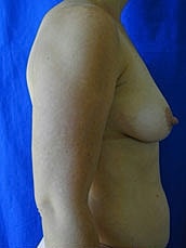Breast Augmentation With Lift Before & After