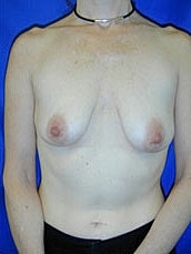 Breast Augmentation With Lift Before & After