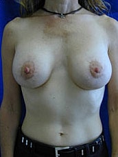 Breast Augmentation With Lift Before & After