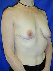 Breast Augmentation With Lift Before & After