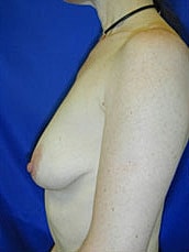 Breast Augmentation With Lift Before & After