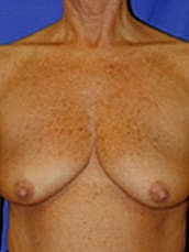 Breast Augmentation With Lift Before & After