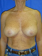 Breast Augmentation With Lift Before & After