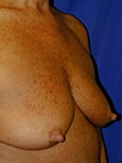 Breast Augmentation With Lift Before & After