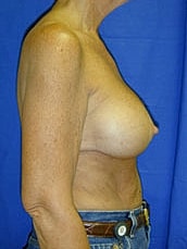 Breast Augmentation With Lift Before & After