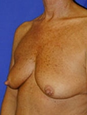 Breast Augmentation With Lift Before & After