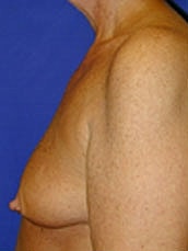 Breast Augmentation With Lift Before & After