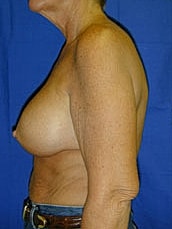 Breast Augmentation With Lift Before & After