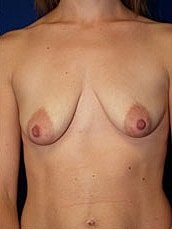 Breast Augmentation With Lift Before & After