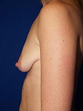 Breast Augmentation With Lift Before & After