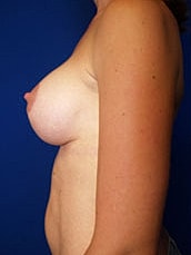 Breast Augmentation With Lift Before & After