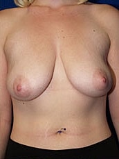 Breast Augmentation With Lift Before & After
