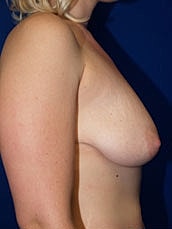 Breast Augmentation With Lift Before & After