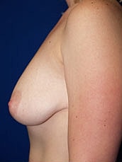Breast Augmentation With Lift Before & After