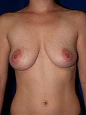 Breast Augmentation With Lift Before & After