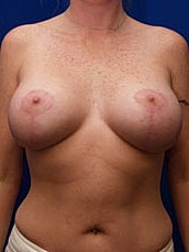 Breast Augmentation With Lift Before & After