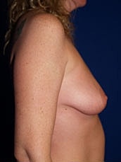Breast Augmentation With Lift Before & After
