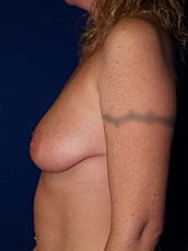 Breast Augmentation With Lift Before & After