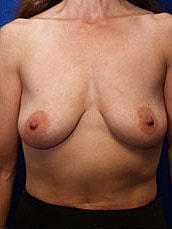 Breast Augmentation With Lift Before & After