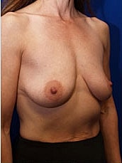 Breast Augmentation With Lift Before & After