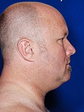 Male Face Neck Before & After