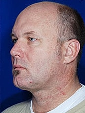 Male Face Neck Before & After