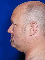 Male Face Neck Before & After
