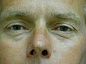 Male Face Neck Before & After