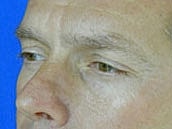 Male Face Neck Before & After