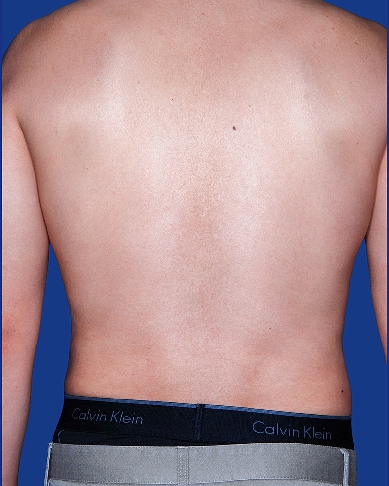 Male Breast Reduction - Gynecomastia Before & After