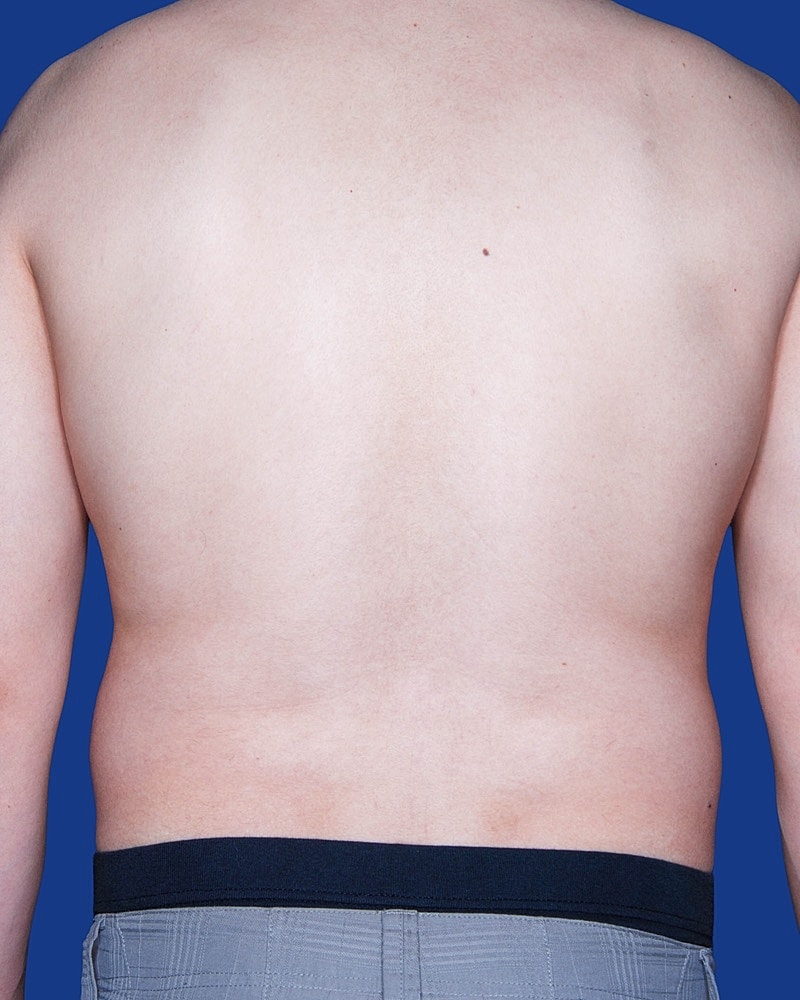 Male Breast Reduction - Gynecomastia Before & After