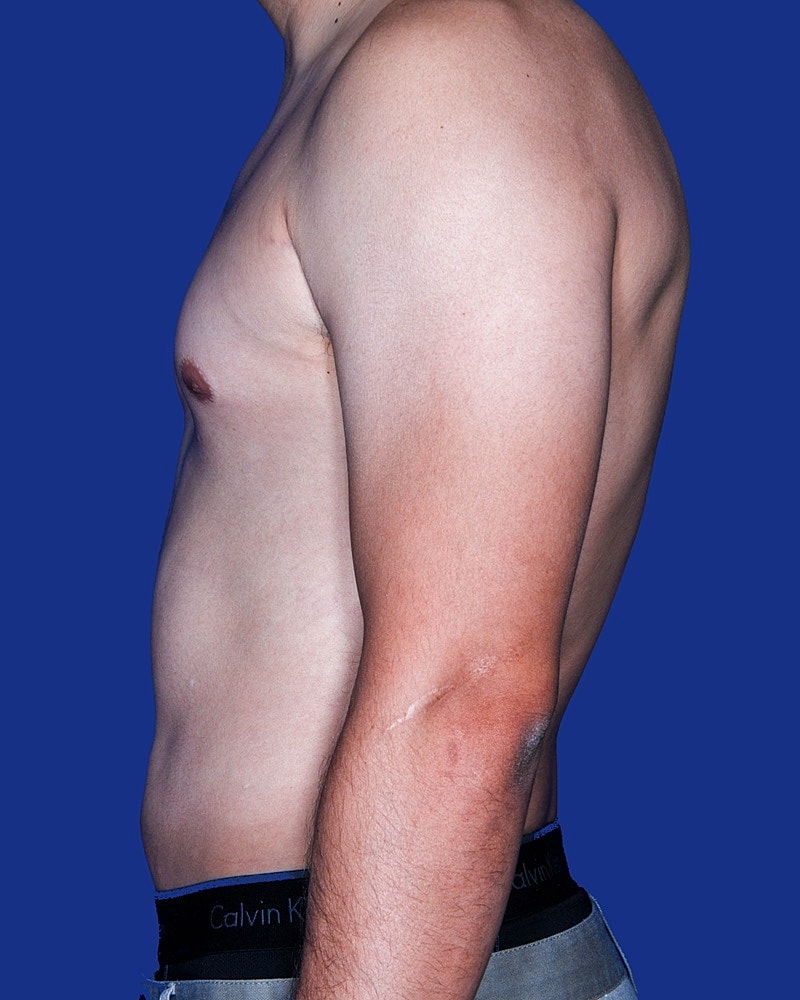 Male Breast Reduction - Gynecomastia Before & After