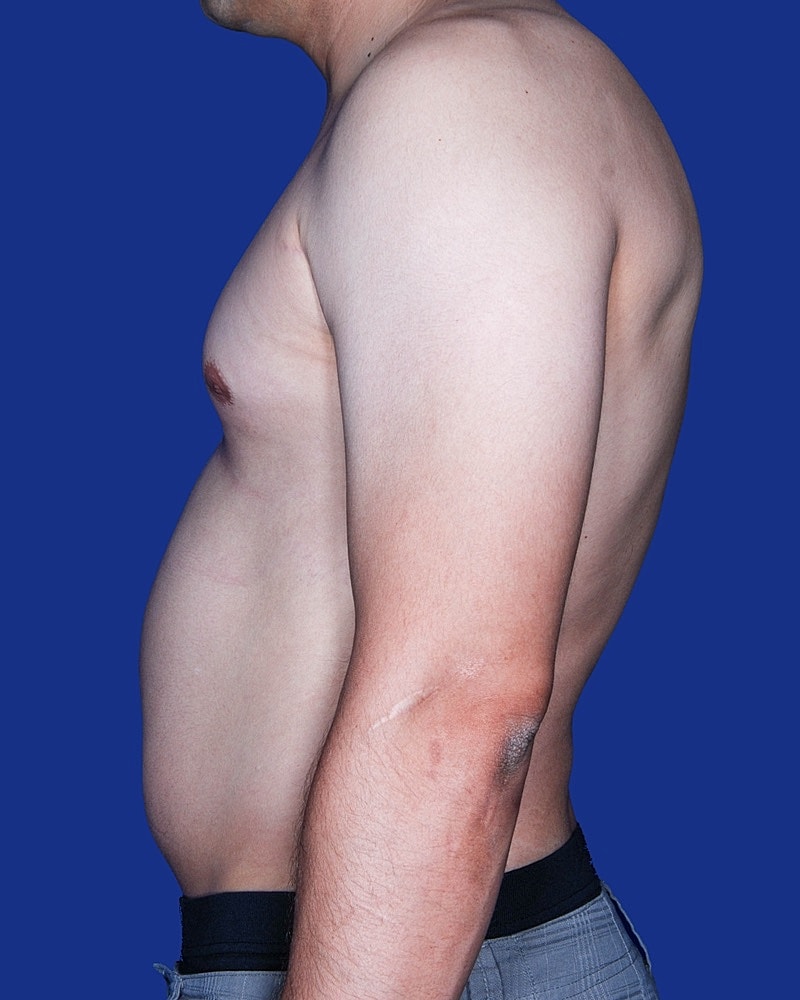 Male Breast Reduction - Gynecomastia Before & After