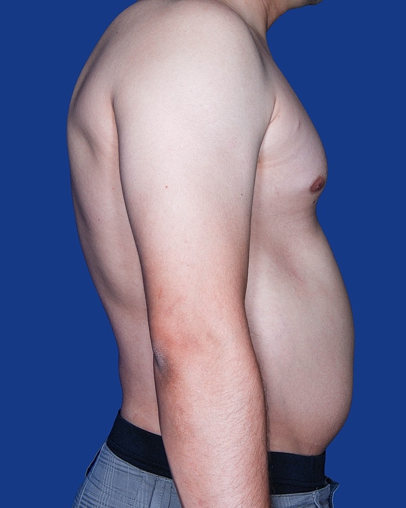 Male Breast Reduction - Gynecomastia Before & After