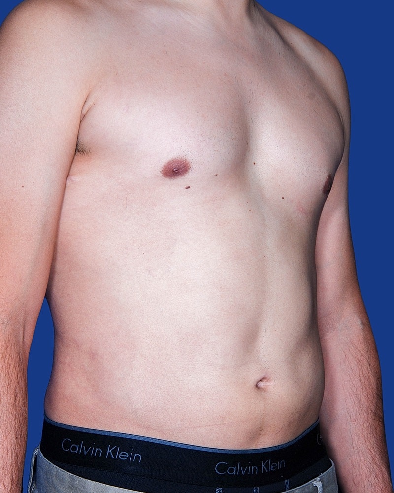 Male Breast Reduction - Gynecomastia Before & After