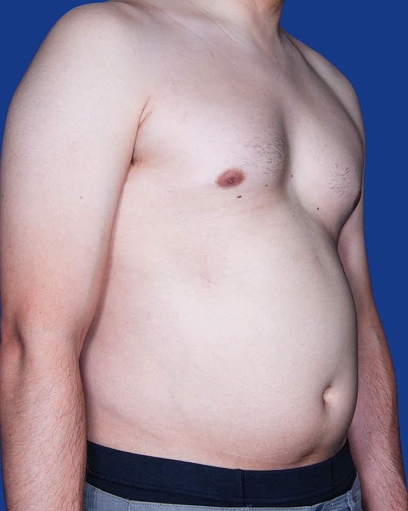 Male Breast Reduction - Gynecomastia Before & After