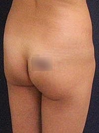 Non Surgical Butt Lift Before & After