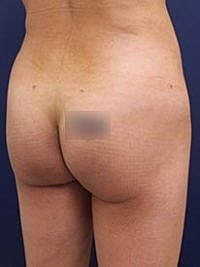 Non Surgical Butt Lift Before & After