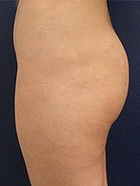 Non Surgical Butt Lift Before & After