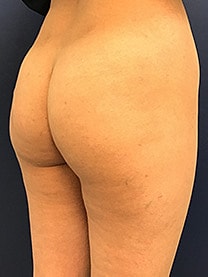 Non Surgical Butt Lift Before & After