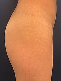 Non Surgical Butt Lift Before & After